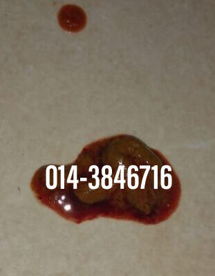 #pil gugur kandungan 1 bulan, #pil gugur kandungan 1 bulan malaysia, #pil gugur kandungan 2 bulan, #pil gugur kandungan 2 bulan malaysia, #pil gugur kandungan 3 bulan malaysia, #pil gugur kandungan 3bulan, #pil gugur kandungan 4 bulan malaysia, #aborsi, #a